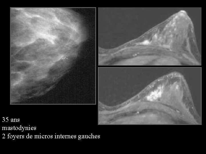 35 ans mastodynies 2 foyers de micros internes gauches 