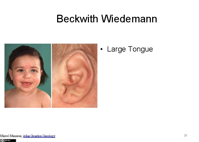 Beckwith Wiedemann • Large Tongue Marcel Mannens, Atlas Genetics Oncology 28 