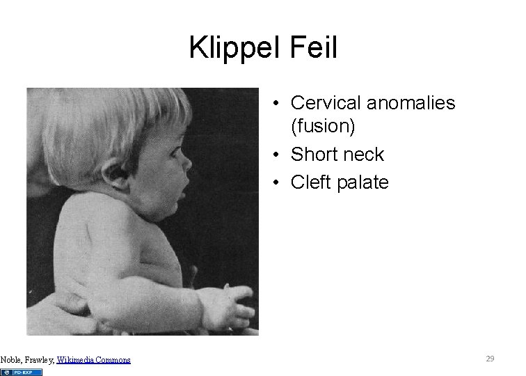Klippel Feil • Cervical anomalies (fusion) • Short neck • Cleft palate Noble, Frawley,