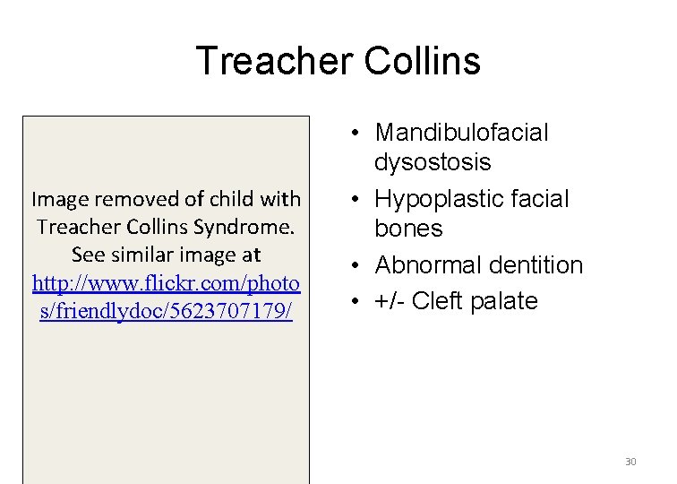 Treacher Collins Image removed of child with Treacher Collins Syndrome. See similar image at