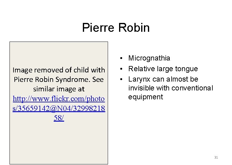 Pierre Robin Image removed of child with Pierre Robin Syndrome. See similar image at