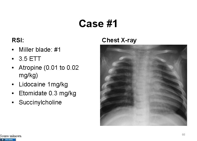 Case #1 RSI: Chest X-ray • Miller blade: #1 • 3. 5 ETT •