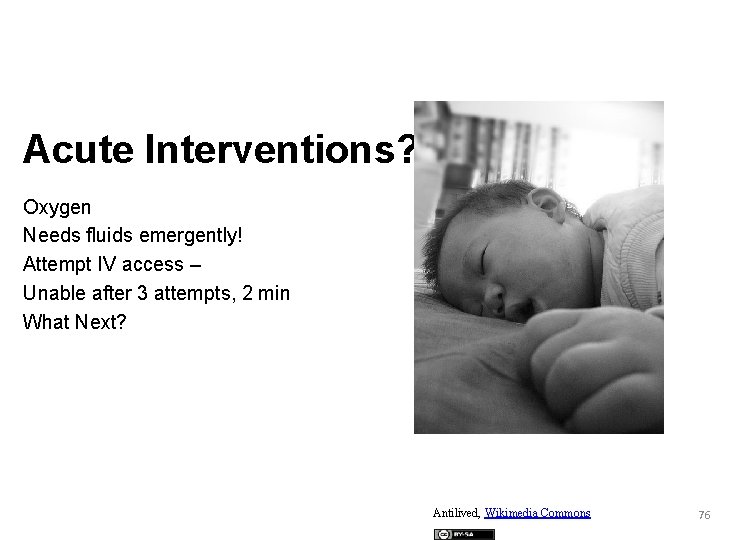 Acute Interventions? Oxygen Needs fluids emergently! Attempt IV access – Unable after 3 attempts,