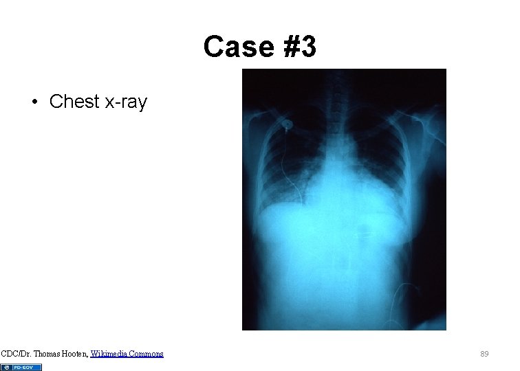 Case #3 • Chest x-ray CDC/Dr. Thomas Hooten, Wikimedia Commons 89 