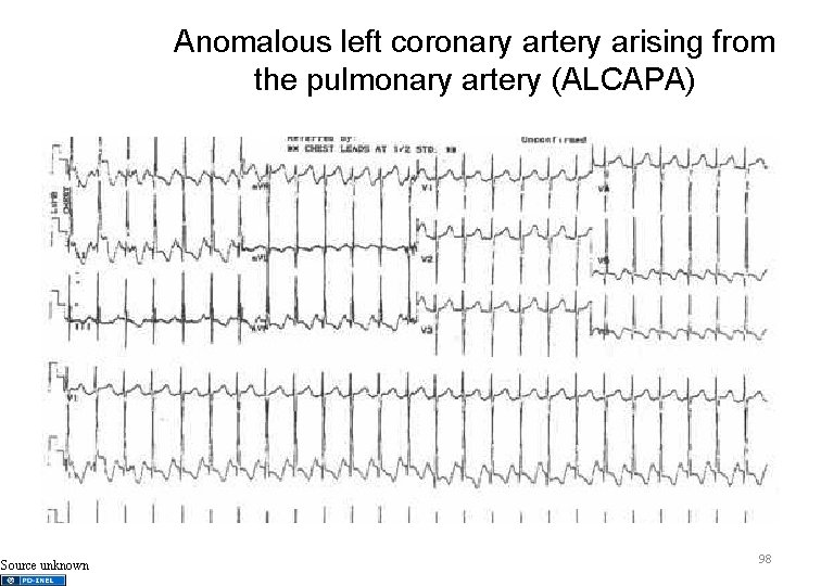 Anomalous left coronary artery arising from the pulmonary artery (ALCAPA) Source unknown 98 