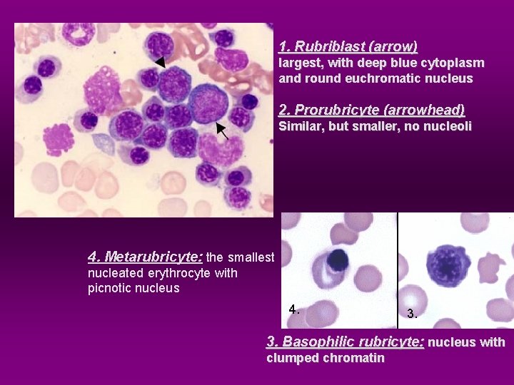 1. Rubriblast (arrow) largest, with deep blue cytoplasm and round euchromatic nucleus 2. Prorubricyte