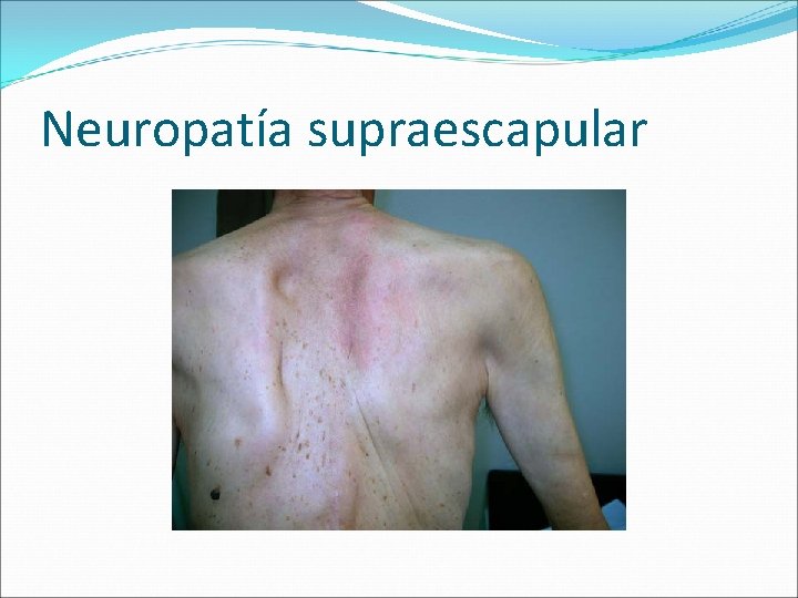 Neuropatía supraescapular 