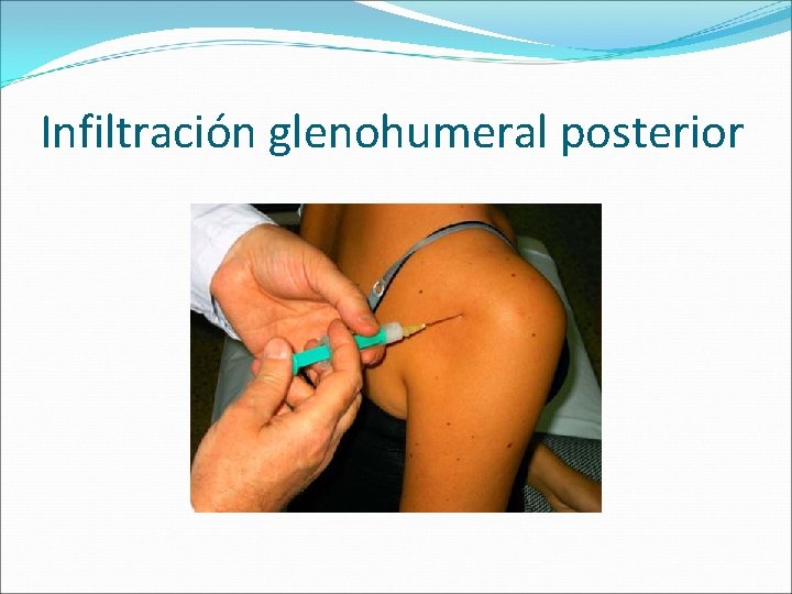 Infiltración glenohumeral posterior 