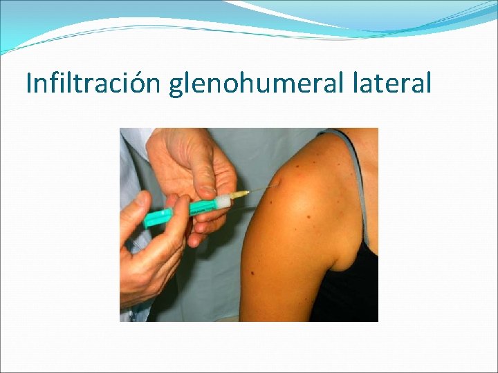 Infiltración glenohumeral lateral 