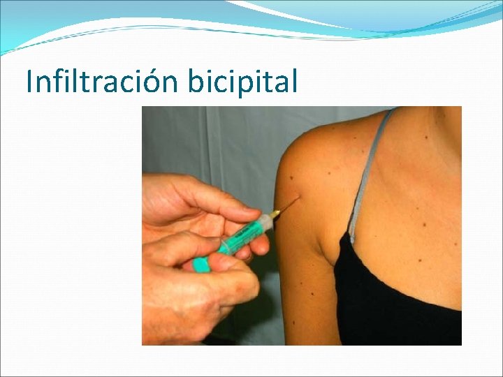 Infiltración bicipital 