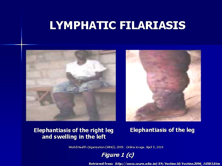 LYMPHATIC FILARIASIS Elephantiasis of the right leg and swelling in the left Elephantiasis of