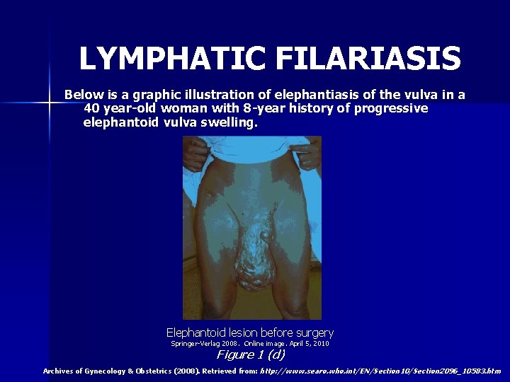 LYMPHATIC FILARIASIS Below is a graphic illustration of elephantiasis of the vulva in a