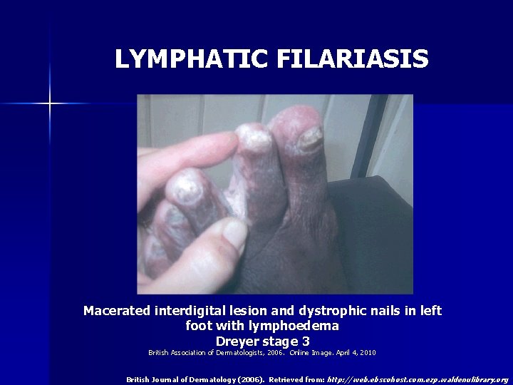 LYMPHATIC FILARIASIS Macerated interdigital lesion and dystrophic nails in left foot with lymphoedema Dreyer