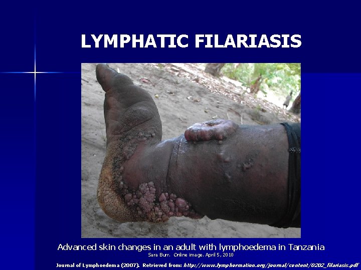LYMPHATIC FILARIASIS Advanced skin changes in an adult with lymphoedema in Tanzania Sara Burr.