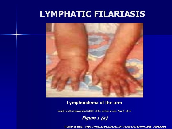 LYMPHATIC FILARIASIS Lymphoedema of the arm World Health Organization (WHO), 2009. Online image. April