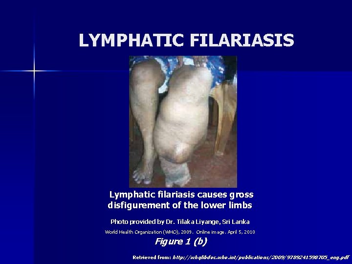 LYMPHATIC FILARIASIS Lymphatic filariasis causes gross disfigurement of the lower limbs Photo provided by