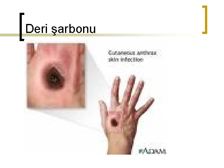 Deri şarbonu 