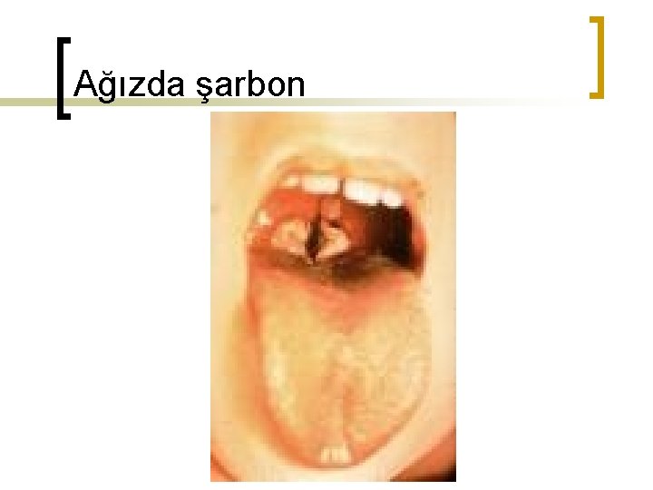 Ağızda şarbon 