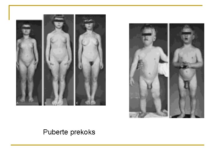 Puberte prekoks 