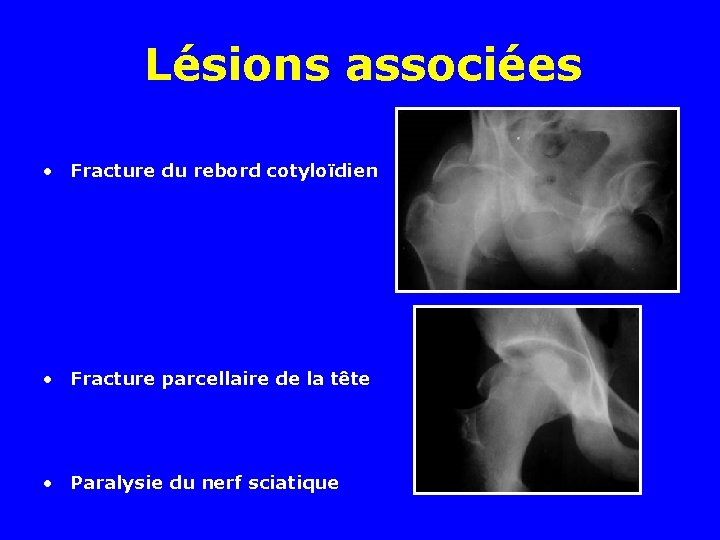 Lésions associées • Fracture du rebord cotyloïdien • Fracture parcellaire de la tête •