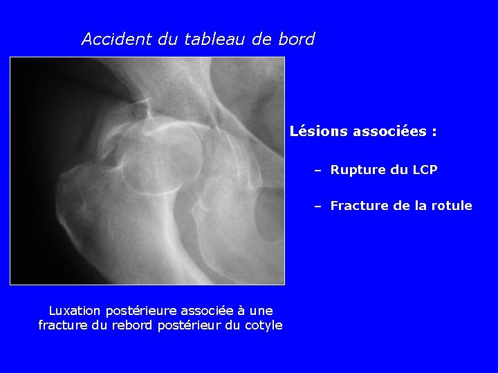 Accident du tableau de bord Lésions associées : – Rupture du LCP – Fracture