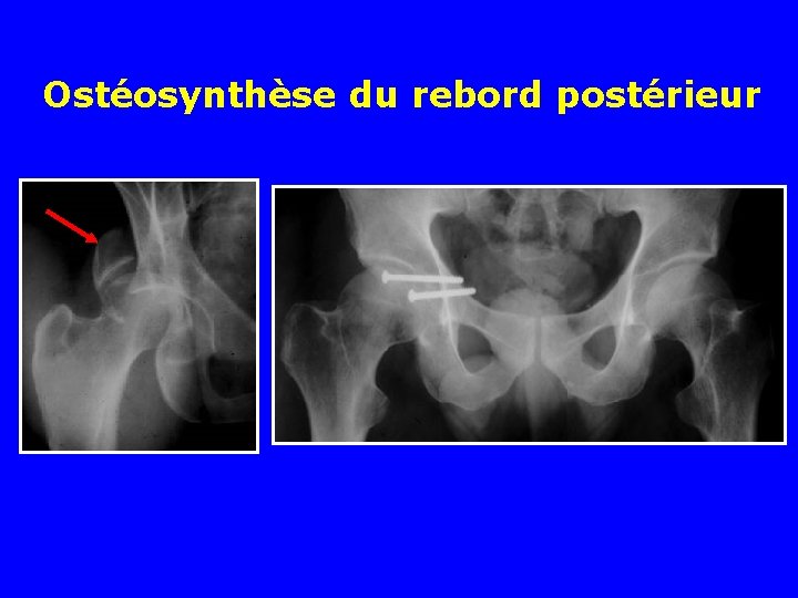 Ostéosynthèse du rebord postérieur 