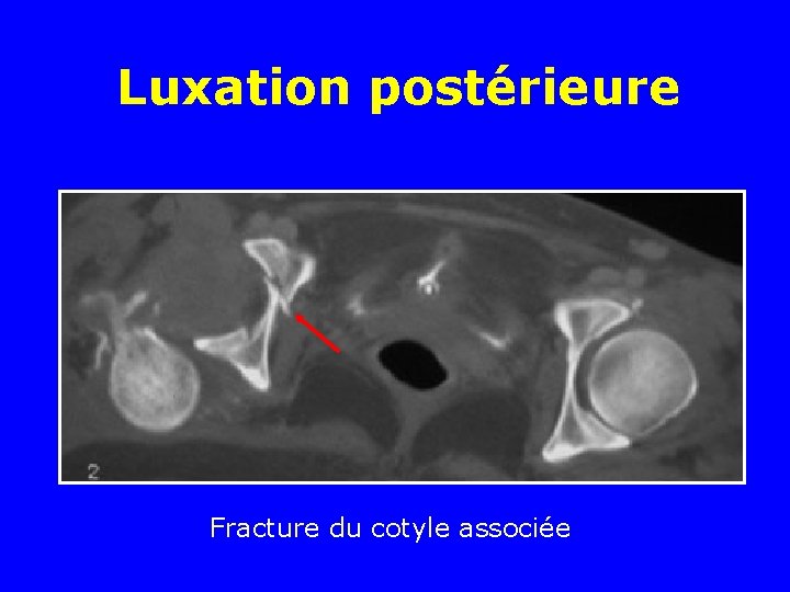 Luxation postérieure Fracture du cotyle associée 