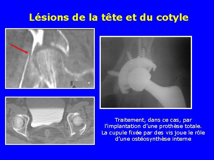 Lésions de la tête et du cotyle Traitement, dans ce cas, par l’implantation d’une