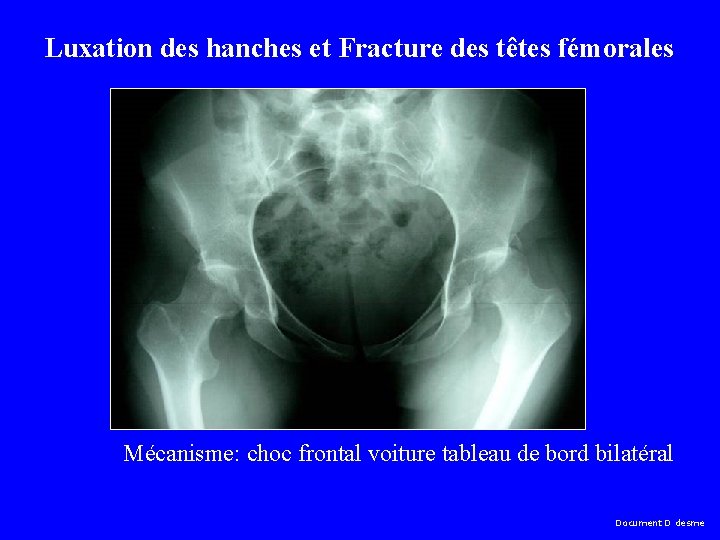 Luxation des hanches et Fracture des têtes fémorales Mécanisme: choc frontal voiture tableau de