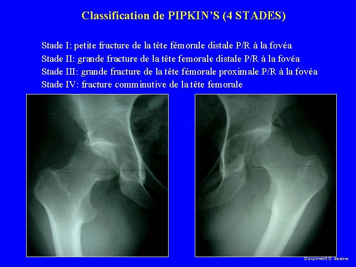 Classification de PIPKIN’S (4 STADES) Stade I: petite fracture de la tête fémorale distale