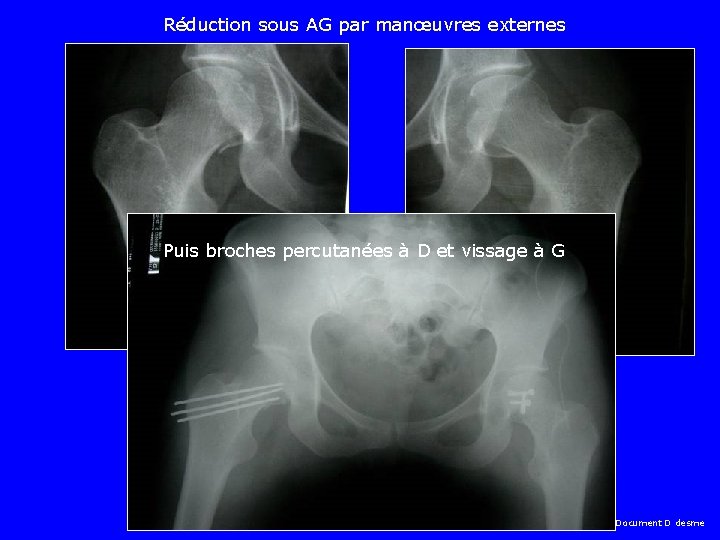 Réduction sous AG par manœuvres externes Puis broches percutanées à D et vissage à
