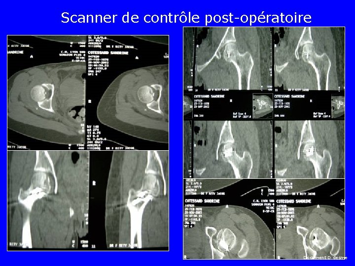 Scanner de contrôle post-opératoire Document D desme 