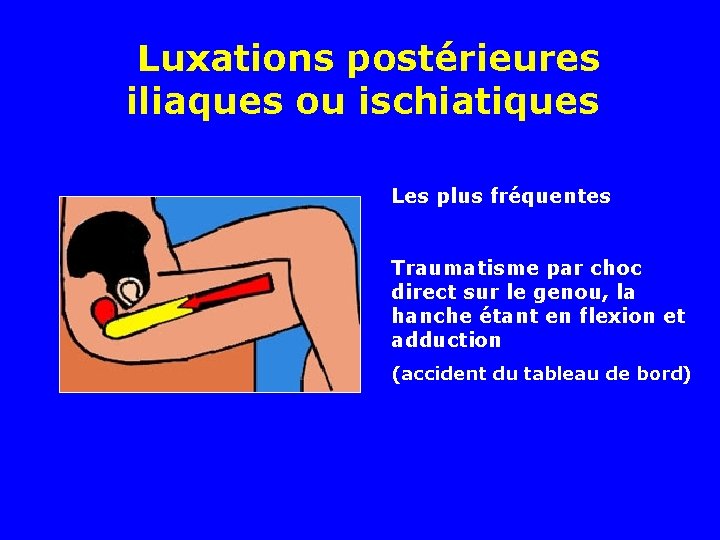 Luxations postérieures iliaques ou ischiatiques Les plus fréquentes Traumatisme par choc direct sur le