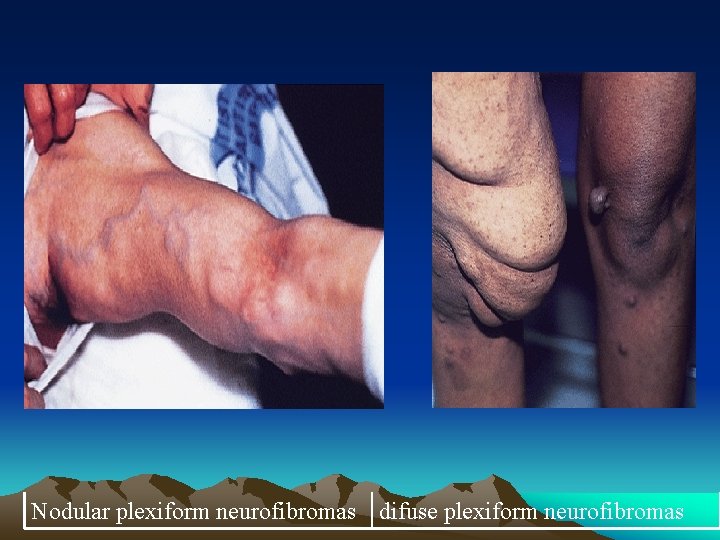 Nodular plexiform neurofibromas difuse plexiform neurofibromas 