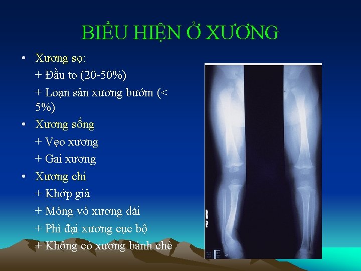 BIỂU HIỆN Ở XƯƠNG • Xương sọ: + Đầu to (20 -50%) + Loạn