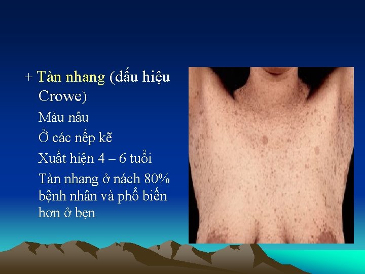 + Tàn nhang (dấu hiệu Crowe) Màu nâu Ở các nếp kẽ Xuất hiện