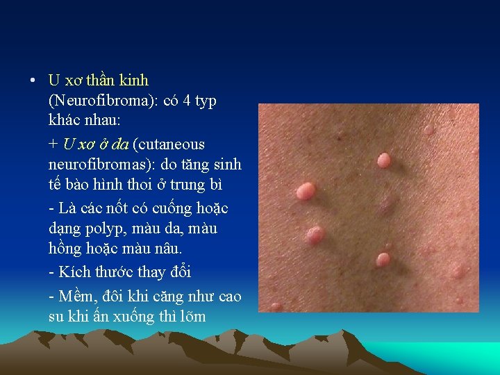  • U xơ thần kinh (Neurofibroma): có 4 typ khác nhau: + U