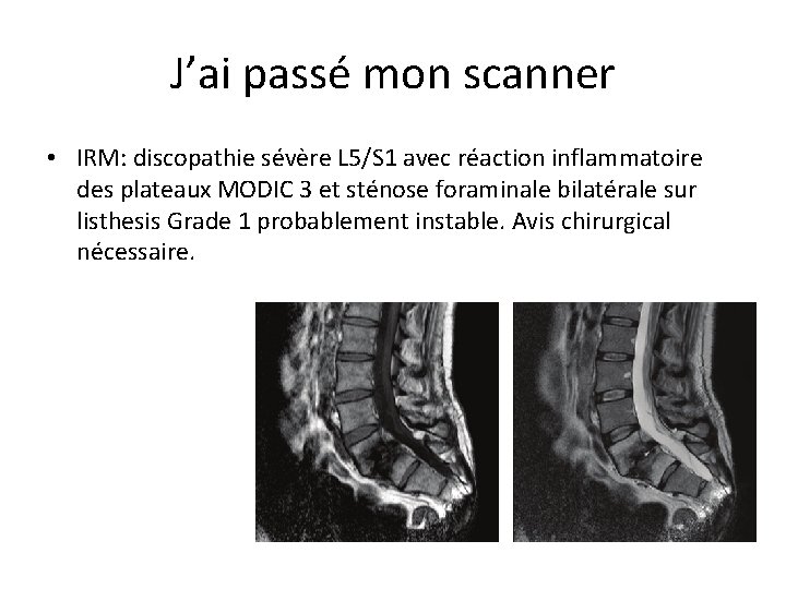 J’ai passé mon scanner • IRM: discopathie sévère L 5/S 1 avec réaction inflammatoire