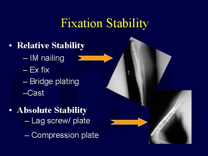 Fixation Stability • Relative Stability – IM nailing – Ex fix – Bridge plating