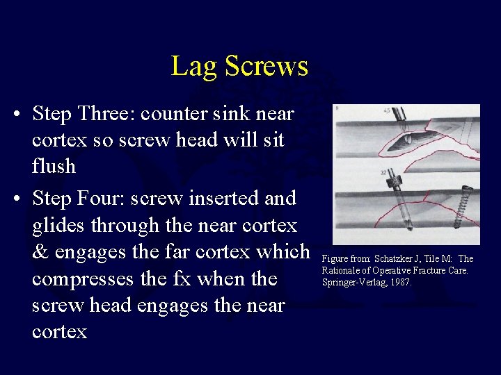 Lag Screws • Step Three: counter sink near cortex so screw head will sit