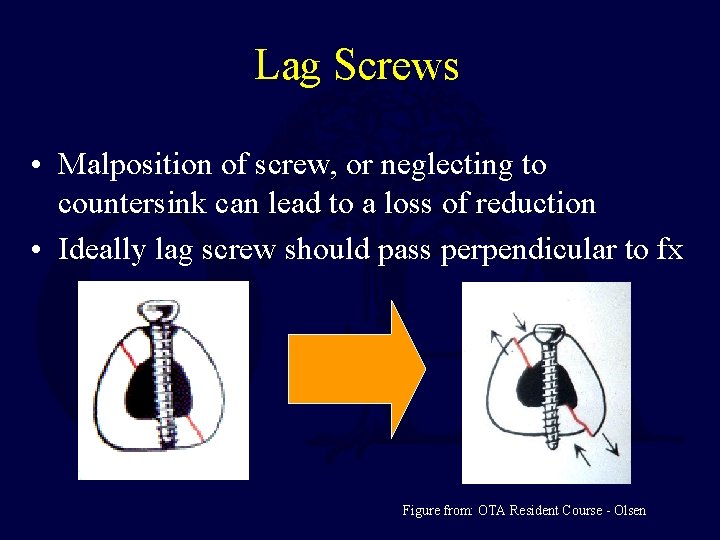 Lag Screws • Malposition of screw, or neglecting to countersink can lead to a