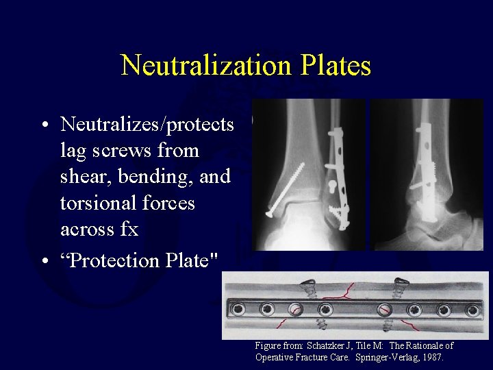 Neutralization Plates • Neutralizes/protects lag screws from shear, bending, and torsional forces across fx