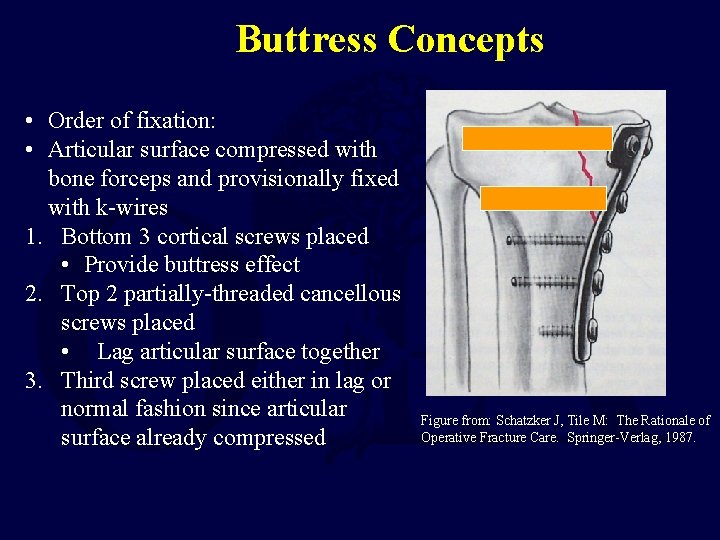 Buttress Concepts • Order of fixation: • Articular surface compressed with bone forceps and