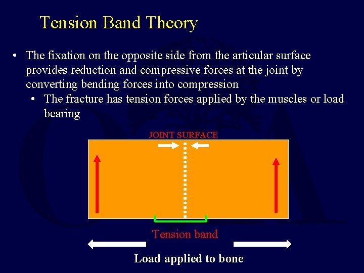 Tension Band Theory • The fixation on the opposite side from the articular surface