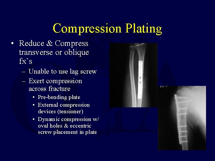 Compression Plating • Reduce & Compress transverse or oblique fx’s – Unable to use
