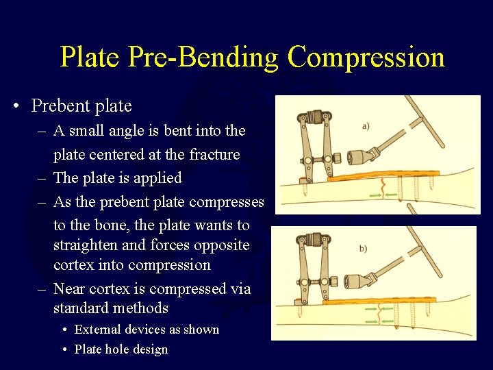 Plate Pre-Bending Compression • Prebent plate – A small angle is bent into the
