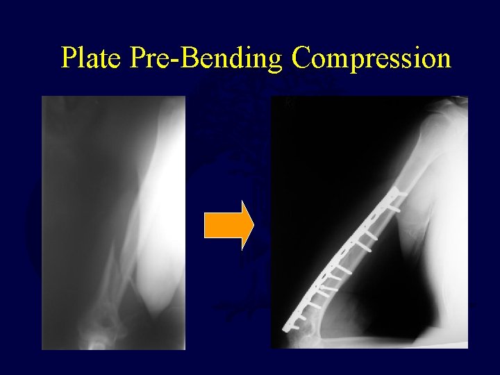 Plate Pre-Bending Compression 