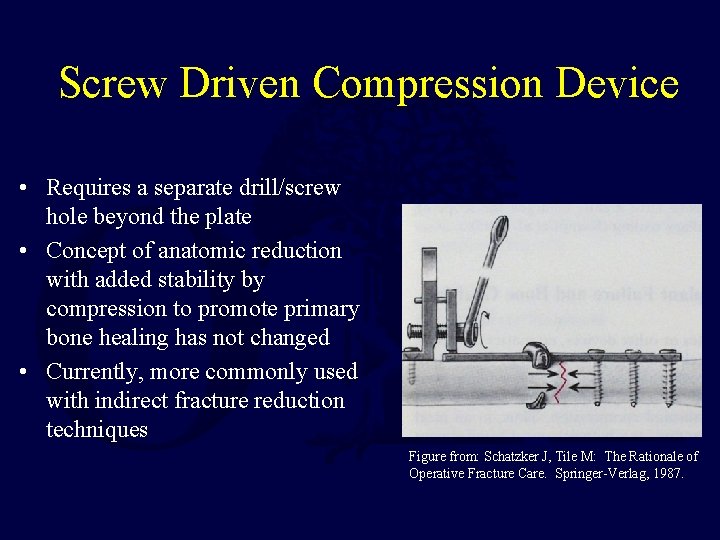 Screw Driven Compression Device • Requires a separate drill/screw hole beyond the plate •