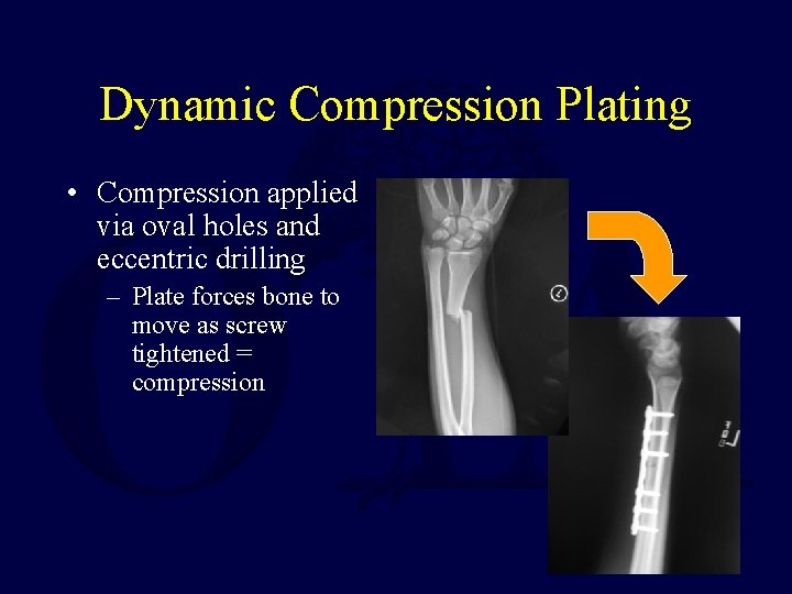 Dynamic Compression Plating • Compression applied via oval holes and eccentric drilling – Plate