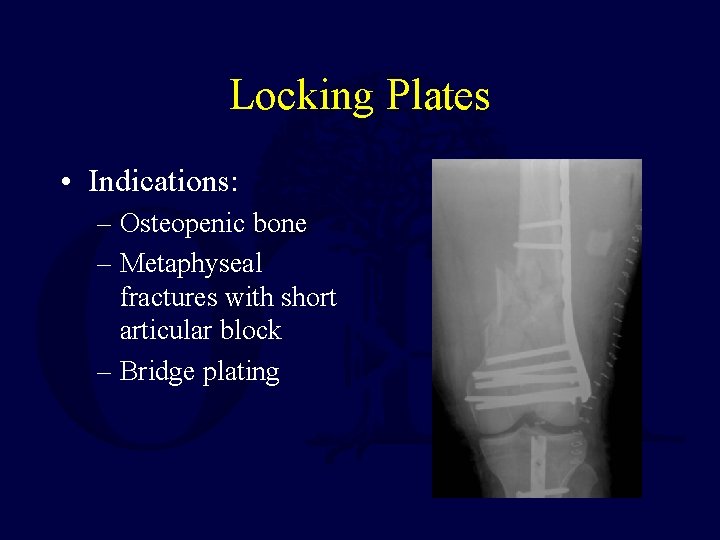 Locking Plates • Indications: – Osteopenic bone – Metaphyseal fractures with short articular block
